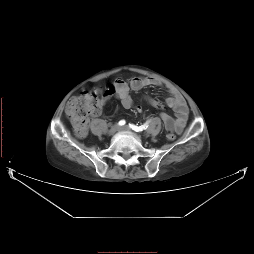 Adrenal hemangioma (Radiopaedia 68923-78668 Axial C+ arterial phase 52).jpg