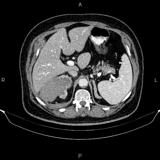 Adrenal hemorrhage (Radiopaedia 62622-70916 Axial C+ portal venous phase 49).jpg