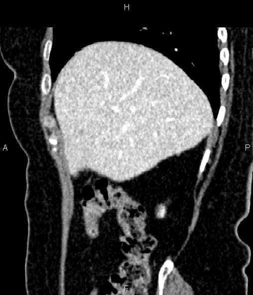 File:Adrenal myelolipoma (Radiopaedia 82742-96986 Sagittal renal cortical phase 28).jpg