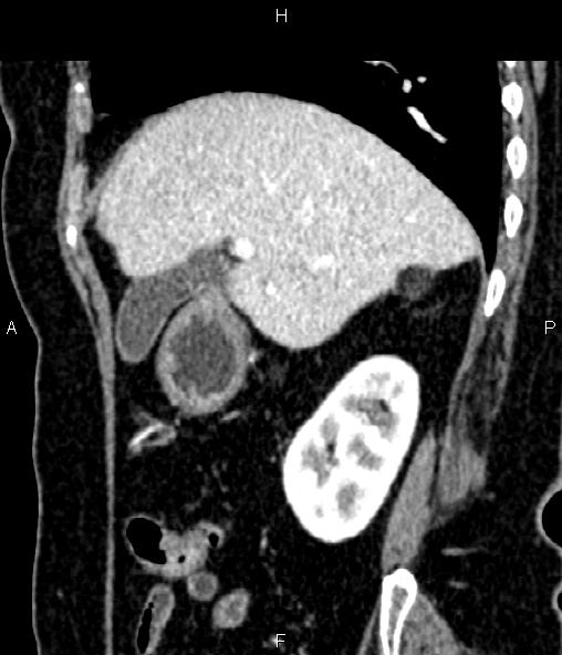 Adrenal myelolipoma (Radiopaedia 82742-96986 Sagittal renal cortical phase 36).jpg
