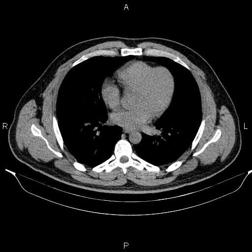 Adrenal myelolipoma (Radiopaedia 84321-99619 Axial non-contrast 2).jpg
