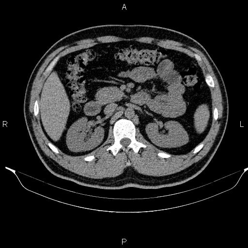 File:Adrenal myelolipoma (Radiopaedia 84321-99619 Axial non-contrast 43).jpg