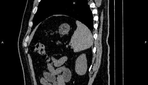 Adrenal myelolipoma (Radiopaedia 84321-99619 Sagittal non-contrast 89).jpg