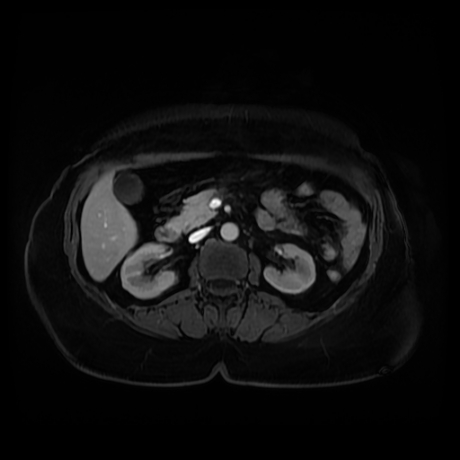 Adrenal myelolipoma - MRI (Radiopaedia 83249-97646 T1 fat sat arterial phase 46).jpg