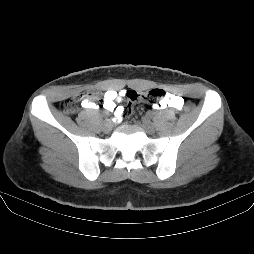Adrenal myelolipoma - bilateral (Radiopaedia 74805-85810 Axial non-contrast 60).jpg