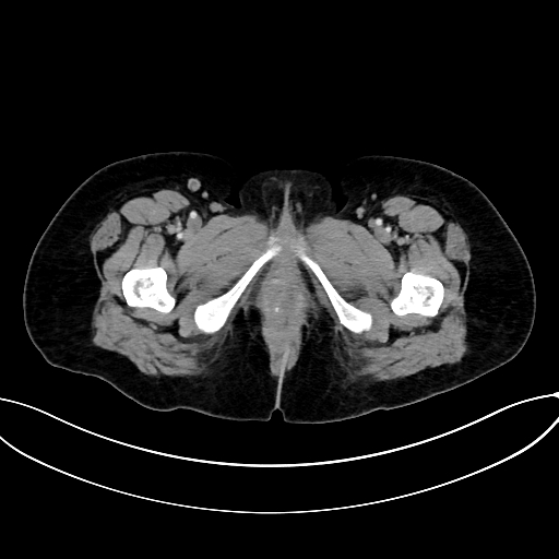 Adrenocortical carcinoma (Radiopaedia 87281-103569 Axial C+ portal venous phase 93).jpg