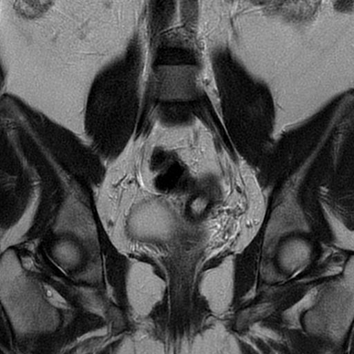 File:Adult granulosa cell tumor of the ovary (Radiopaedia 64991-73953 Coronal T2 13).jpg