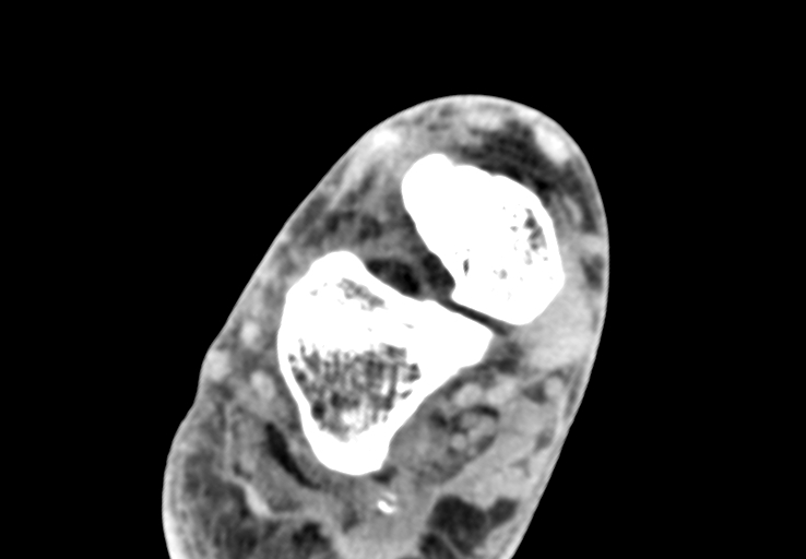 Advanced osteomyelitis due to open metatarsal fracture (Radiopaedia 83891-99095 Axial non-contrast 13).jpg