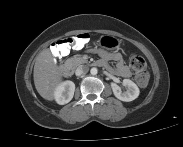 File:Agenesis of the dorsal pancreas (Radiopaedia 11180-11545 Axial 3).jpg