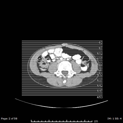 Agenesis of the gallbladder (Radiopaedia 55454-61905 B 2).jpg