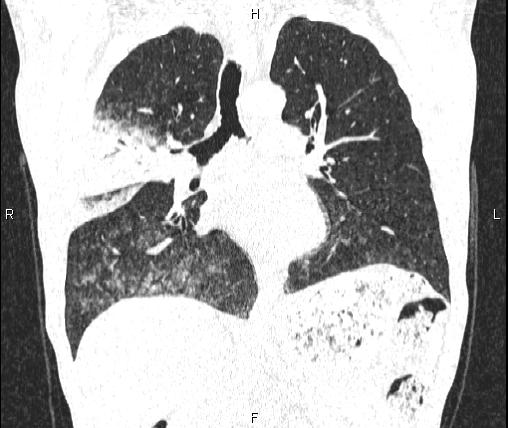 File:Air bronchogram in pneumonia (Radiopaedia 85719-101512 Coronal lung window 31).jpg