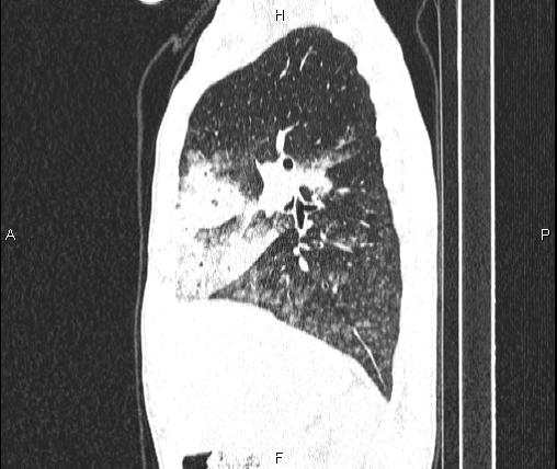 Air bronchogram in pneumonia (Radiopaedia 85719-101512 Sagittal lung window 36).jpg