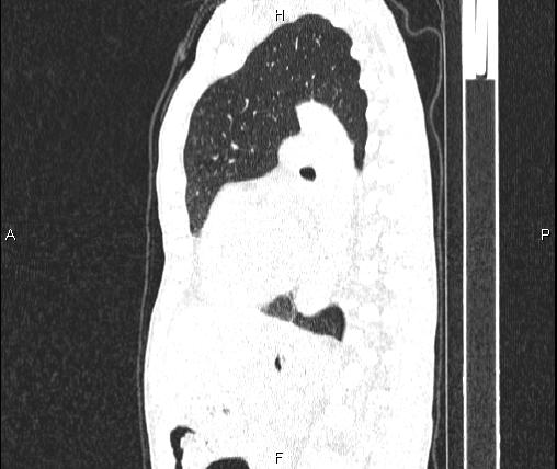 Air bronchogram in pneumonia (Radiopaedia 85719-101512 Sagittal lung window 61).jpg