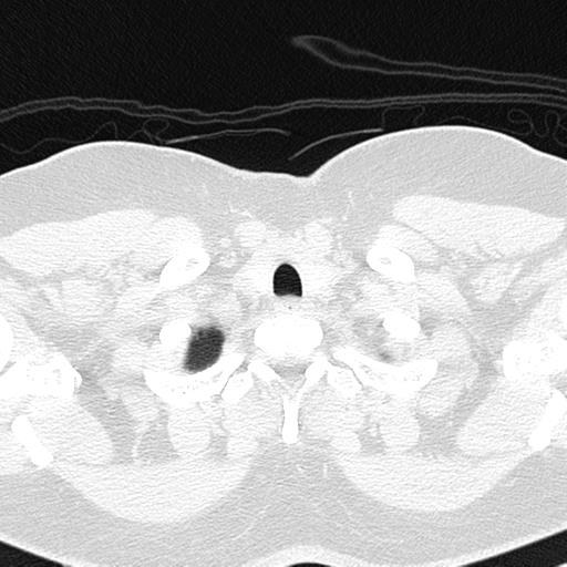 File:Air trapping in small airway disease (Radiopaedia 61685-69694 Axial lung window 8).jpg