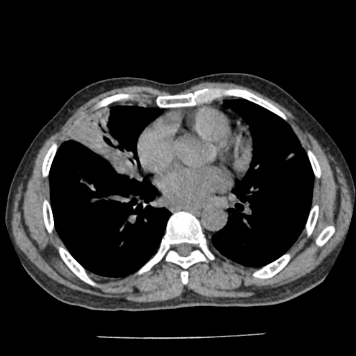 Airway foreign body in adult (Radiopaedia 85907-101779 Axial liver window 109).jpg