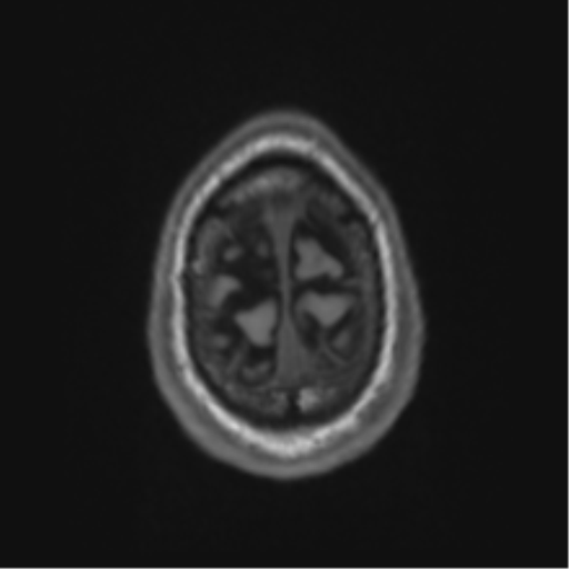 Alzheimer's disease- with Gerstmann syndrome and dressing apraxia (Radiopaedia 54882-61150 Axial T1 70).png