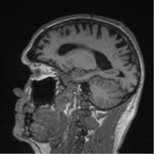 Alzheimer's disease- with Gerstmann syndrome and dressing apraxia (Radiopaedia 54882-61150 Sagittal T1 24).png