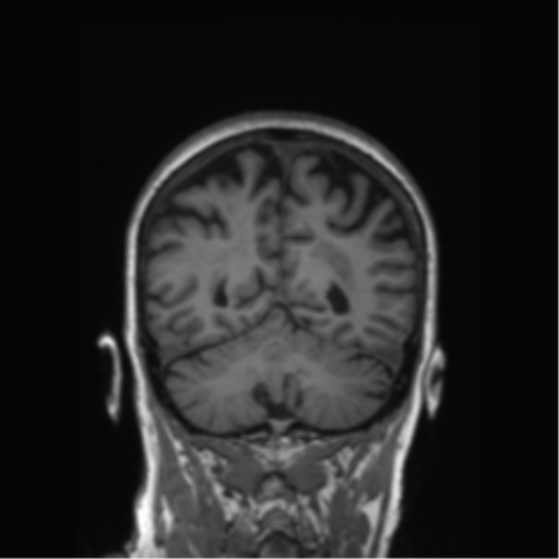 Alzheimer's disease (Radiopaedia 42658-45802 Coronal T1 60).png