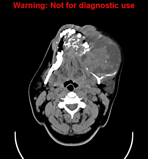 File:Ameloblastoma (Radiopaedia 33126-34164 A 10).jpg