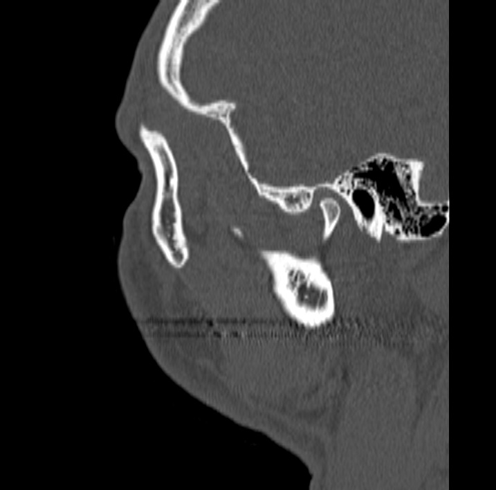 Ameloblastoma (Radiopaedia 77750-89997 Sagittal bone window 112).jpg