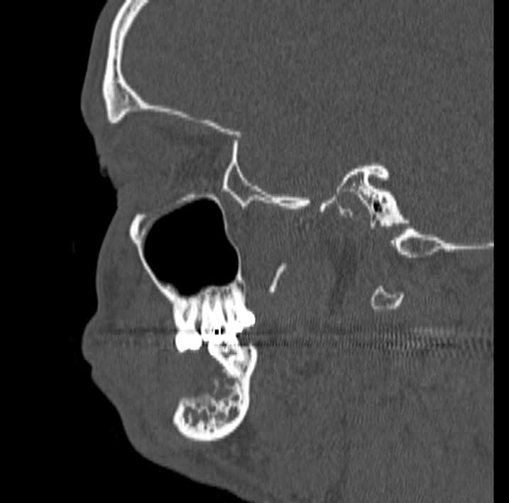 Ameloblastoma (Radiopaedia 77750-89997 Sagittal bone window 51).jpg