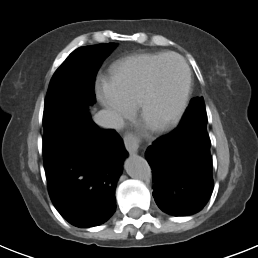 File:Ampullary adenocarcinoma (Radiopaedia 34013-35237 Axial non-contrast 3).png