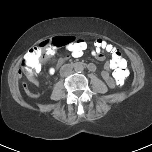 File:Ampullary adenocarcinoma (Radiopaedia 34013-35237 Axial non-contrast 34).png