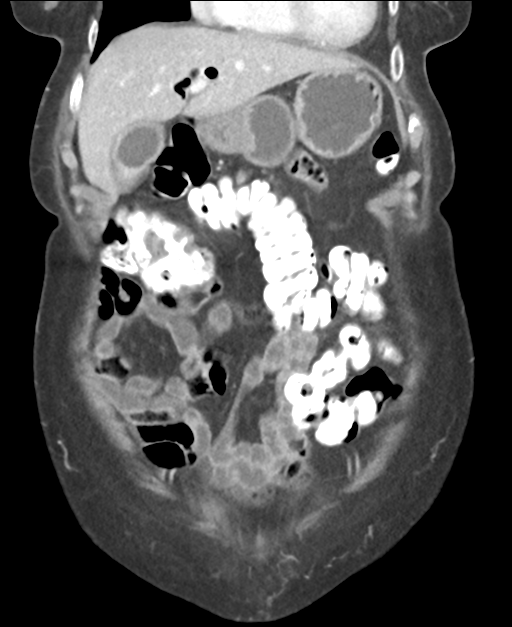 Ampullary adenocarcinoma (Radiopaedia 34013-35237 E 16).png