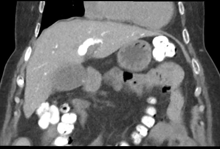 Ampullary adenocarcinoma (Radiopaedia 34013-35241 Coronal 16).png