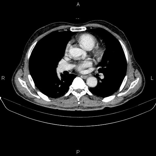 Ampullary adenocarcinoma (Radiopaedia 86093-102032 A 1).jpg