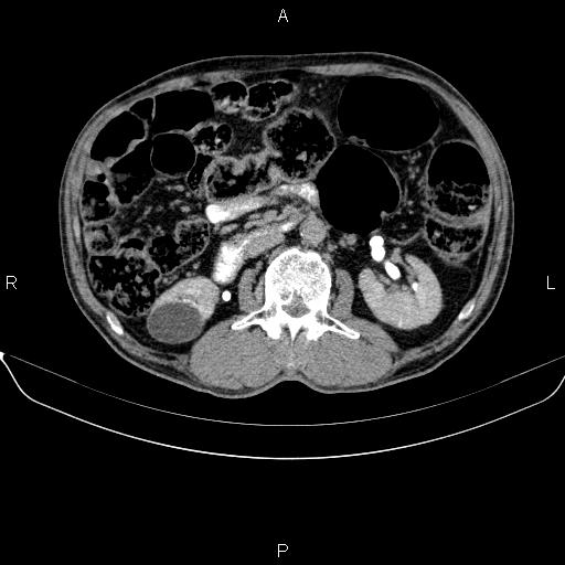 Ampullary adenocarcinoma (Radiopaedia 86093-102032 Axial C+ delayed 48).jpg