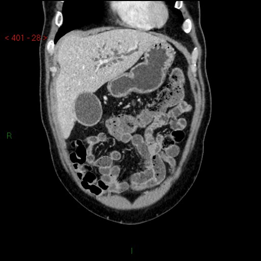 Ampullary carcinoma (Radiopaedia 56396-63056 E 27).jpg