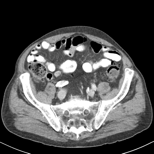 File:Amyand hernia (Radiopaedia 39300-41547 A 53).png