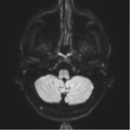 Anaplastic astrocytoma (Radiopaedia 57768-64731 Axial DWI 32).png