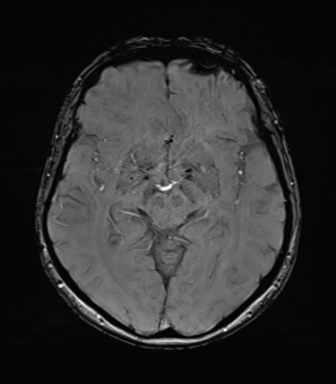 Anaplastic astrocytoma (Radiopaedia 86943-103160 Axial SWI 42).png
