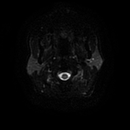 File:Anaplastic astrocytoma (WHO grade III) (Radiopaedia 23559-23664 Axial DWI 21).jpg