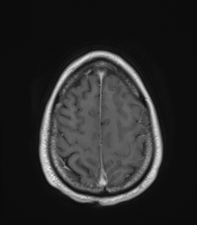 File:Anaplastic astrocytoma IDH wild-type (Radiopaedia 49984-55273 Axial T1 C+ 48).png
