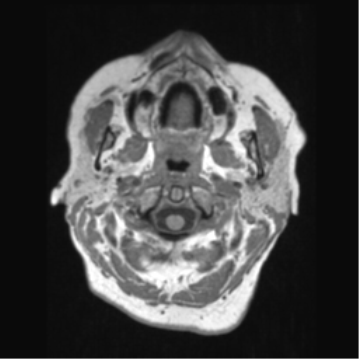 File:Anaplastic astrocytoma IDH wild-type (pseudoprogression) (Radiopaedia 42209-45276 Axial T1 10).png