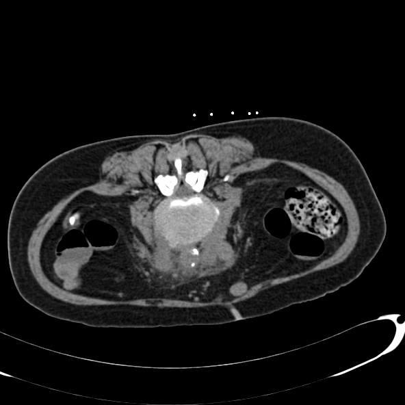 Anaplastic lymphoma - with CT biopsy (Radiopaedia 21643-21602 Axial non-contrast 51).jpg