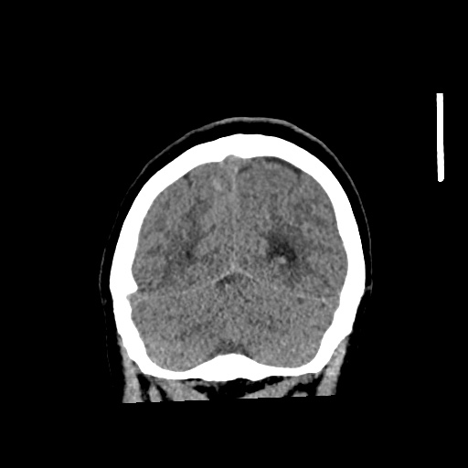 File:Aneursym related subarachnoid hemorrhage with hydrocephalus (Radiopaedia 45105-49083 Coronal non-contrast 55).jpg
