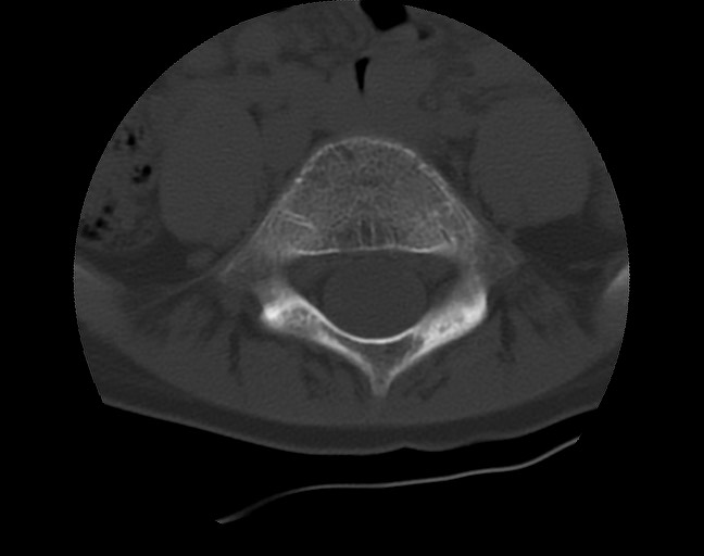 Aneurysmal bone cyst - sacrum (Radiopaedia 65190-74195 Axial bone window 10).jpg