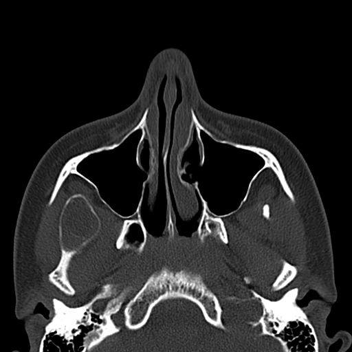 File:Aneurysmal bone cyst of the mandible (Radiopaedia 43280-46601 Axial bone window 70).jpg