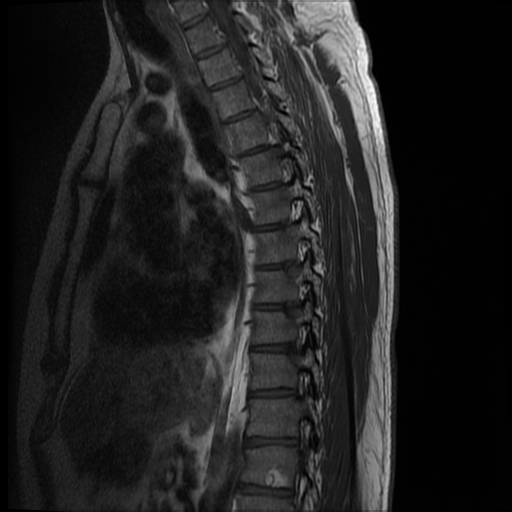 File:Angiolipoma - thoracic spine (Radiopaedia 28242-28479 Sagittal T1 5).jpg