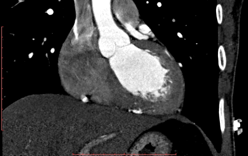 Anomalous left coronary artery from the pulmonary artery (ALCAPA) (Radiopaedia 70148-80181 B 137).jpg