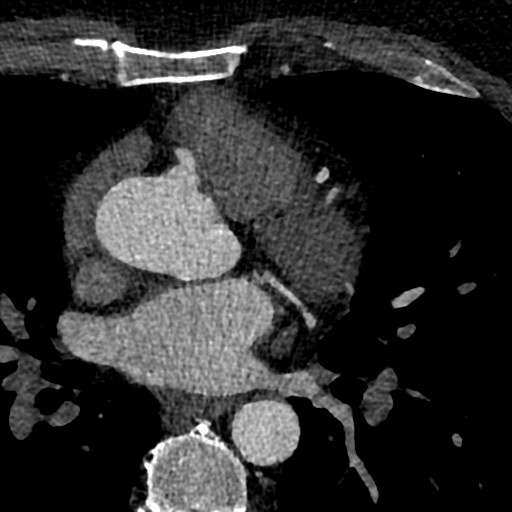File:Anomalous origin of the left coronary artery with malignant course (Radiopaedia 77842-90126 C 54).jpeg