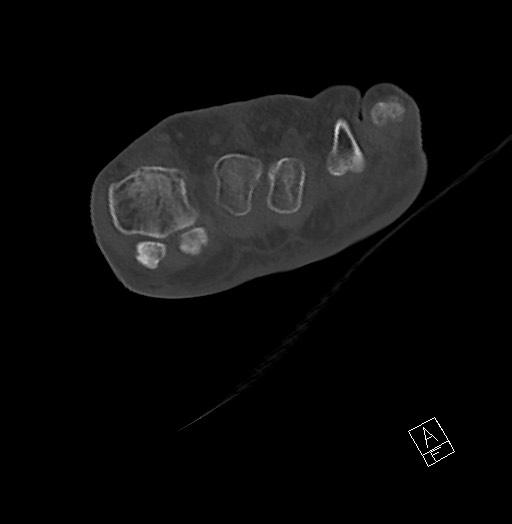 Anterior calcaneal process fracture (Radiopaedia 63353-71943 Axial bone window 42).jpg