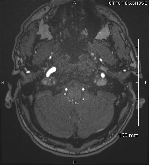 Anterior cerebral artery aneurysm (Radiopaedia 80683-94127 Axial MRA 21).jpg