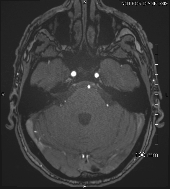 Anterior cerebral artery aneurysm (Radiopaedia 80683-94127 Axial MRA 61).jpg