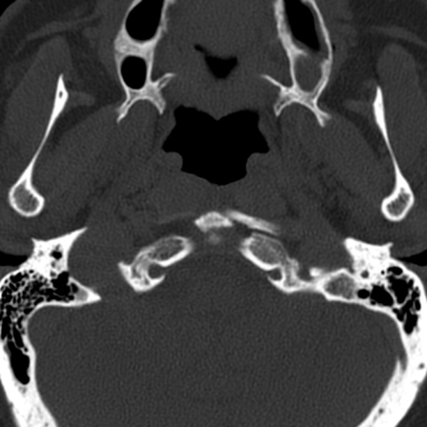 Anterior cervical postdiscectomy arthrodesis (Radiopaedia 32678-33646 Axial bone window 5).jpg