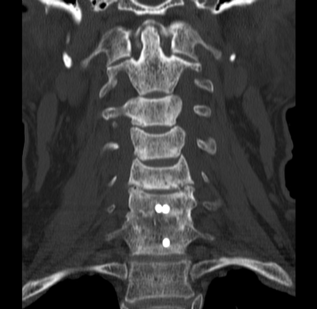 Anterior cervical postdiscectomy arthrodesis (Radiopaedia 32678-33646 Coronal bone window 24).jpg